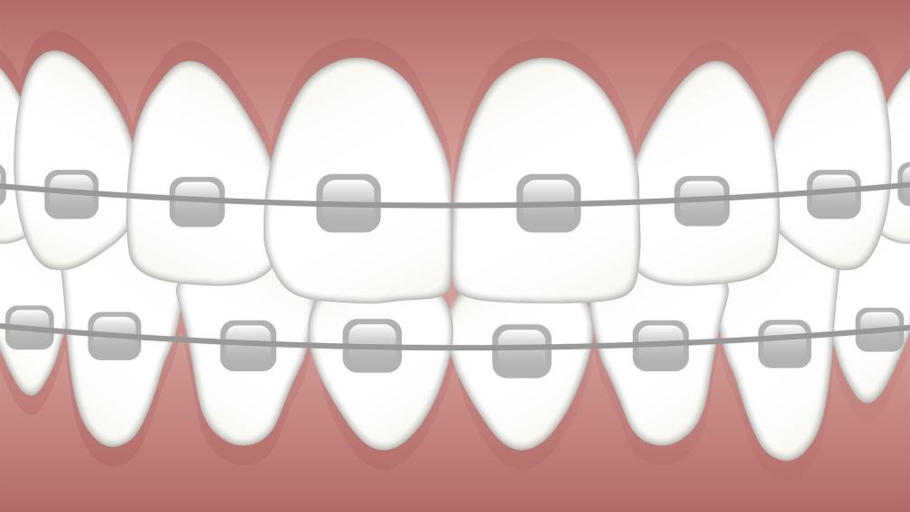 Braces 3597591 1920