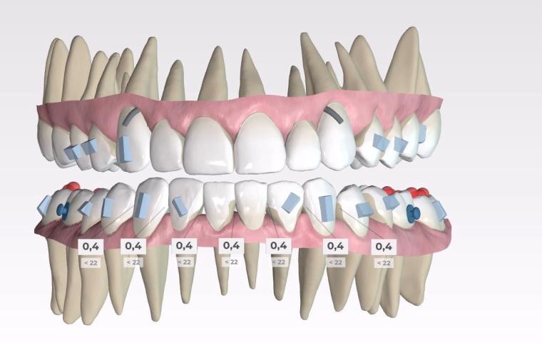 SPARK aligners beugel orthodontie
